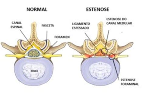 (PDF) Estenose degenerativa do canal lombar.